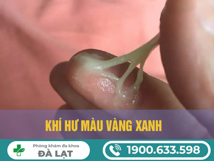 Khí Hư Màu Xanh Vón Cục Như Bã Đậu Kèm Ngứa - Dấu Hiệu Bệnh Phụ Khoa Nguy Hiểm