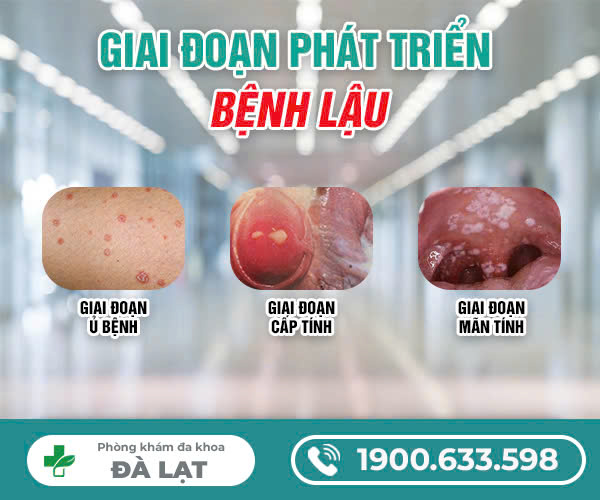 CÁC GIAI ĐOẠN CỦA BỆNH LẬU