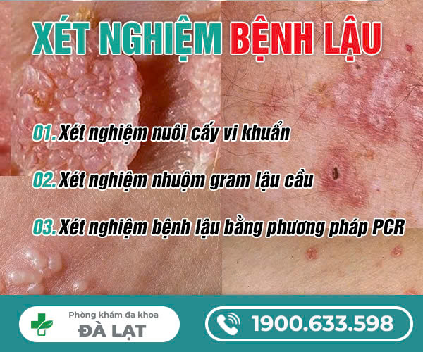 XÉT NGHIỆM BỆNH LẬU.