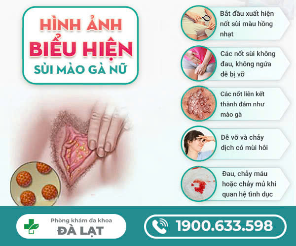 TƯ VẤN VỀ BỆNH SÙI MÀO GÀ Ở CỬA MÌNH NỮ GIỚI