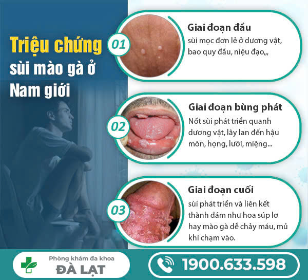 BIỂU HIỆN BỆNH SÙI MÀO GÀ Ở HẬU MÔN