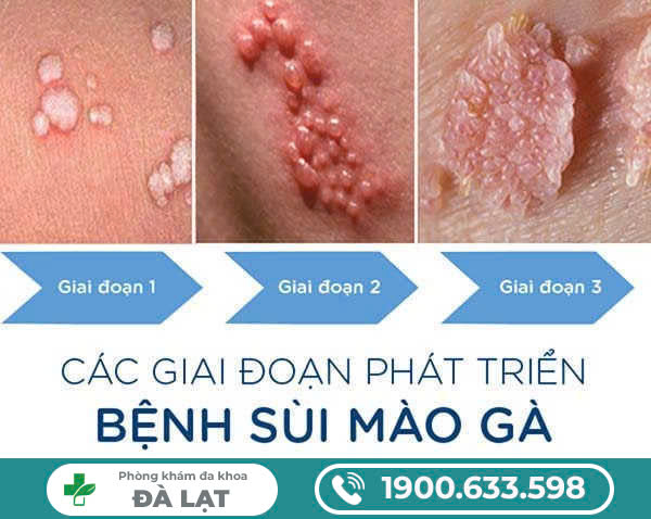 biểu hiện ban đầu của bệnh sùi mào gà