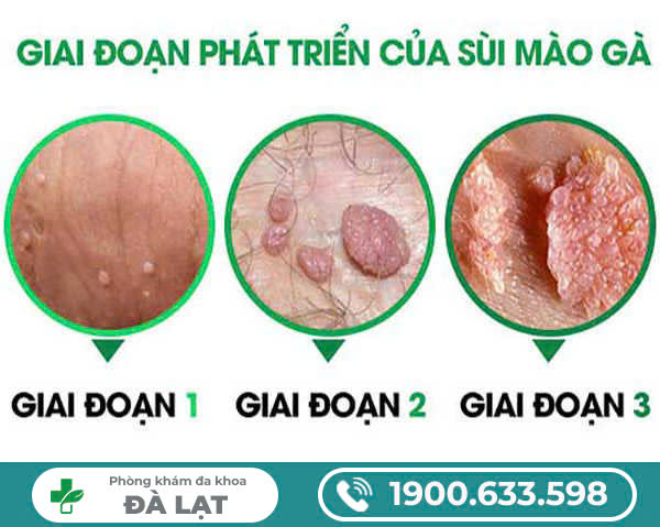 BỆNH SÙI MÀO GÀ GIAI ĐOẠN 2