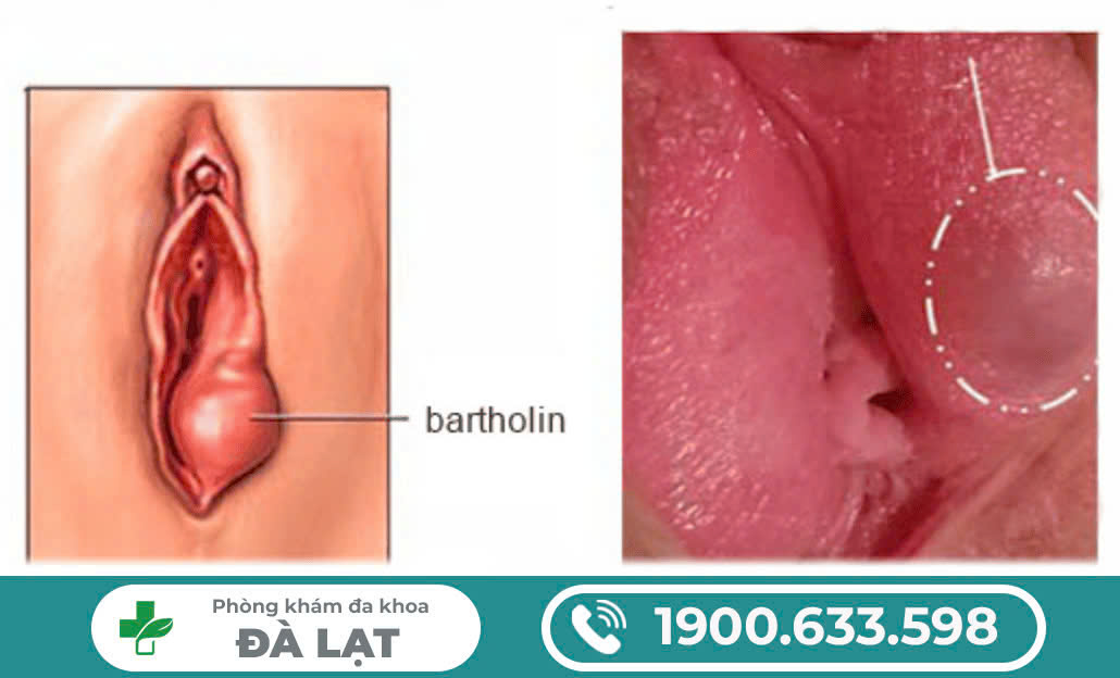 ÂM ĐẠO NỔI CỤC, NỔI HẠCH, NỔI HẠT, NỔI NỐT DO ĐÂU?
