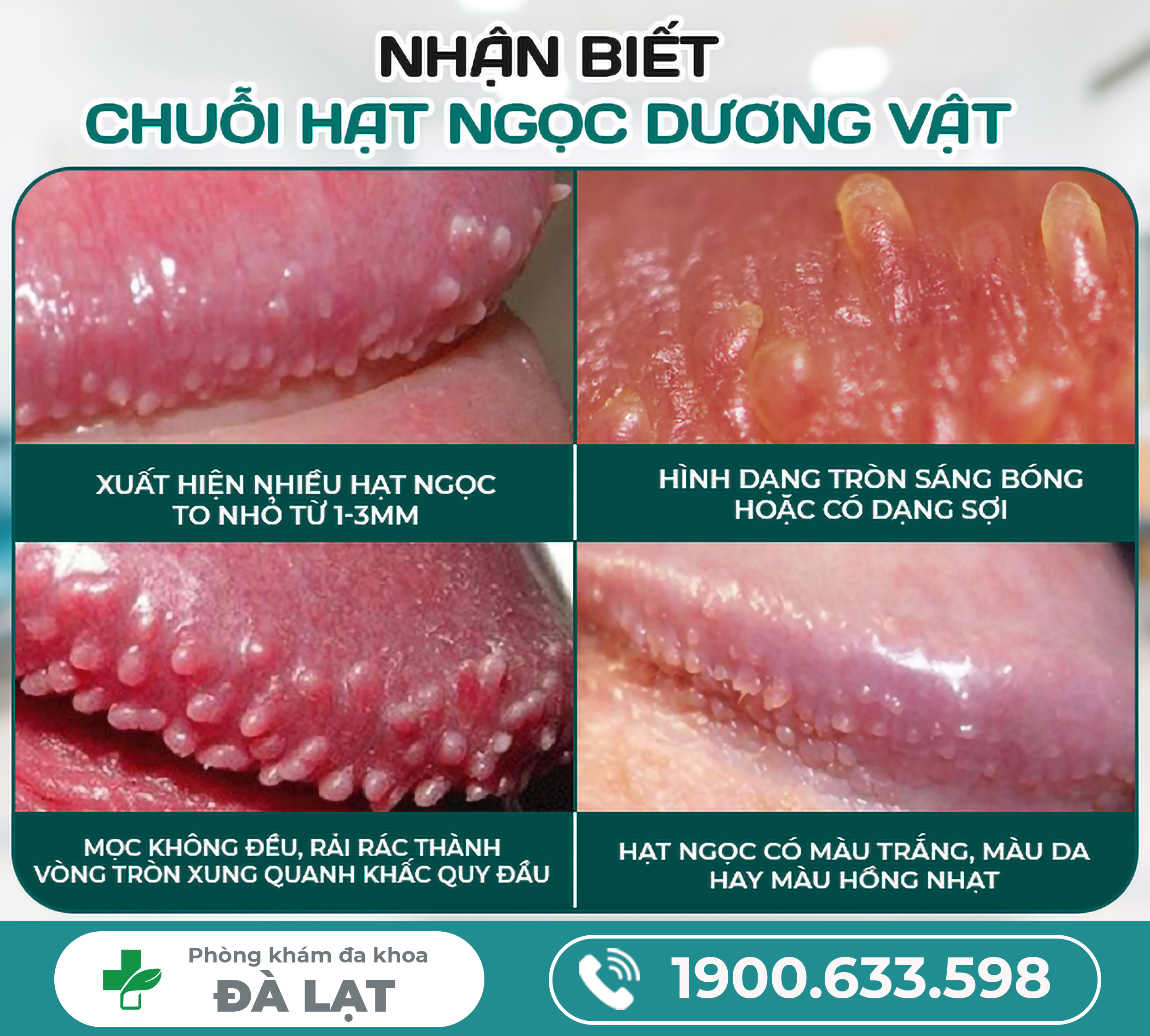 Phân Biệt Sùi Mào Gà và Hạt Ngọc Dương Vật 