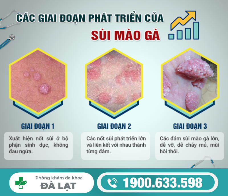 Bệnh Sùi Mào Gà Phát Triển Như Thế Nào? 