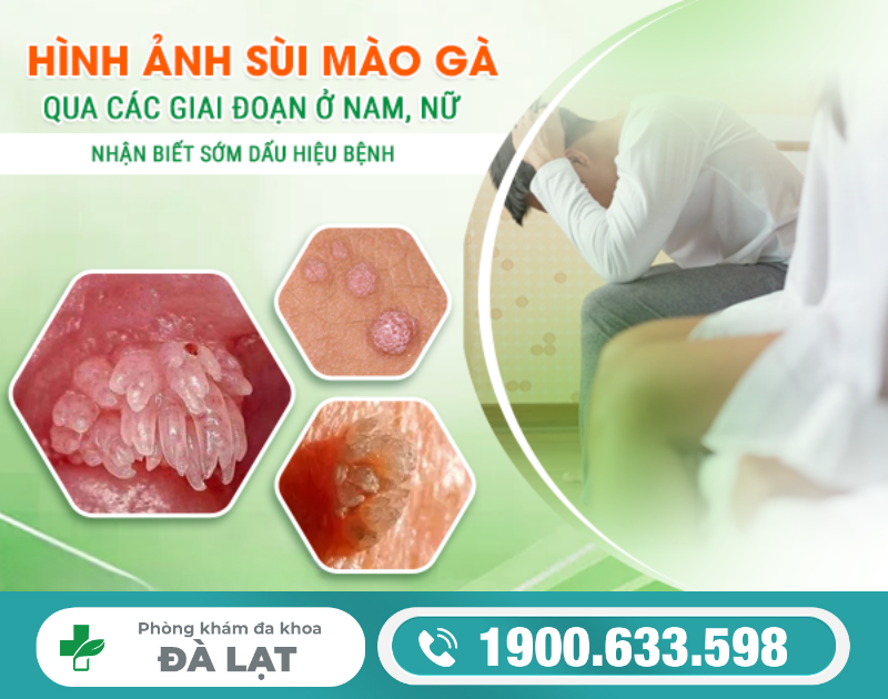 Các Hình Ảnh Của Bệnh Sùi Mào Gà 