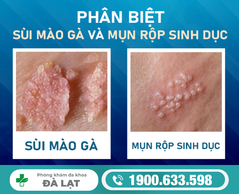 Phân Biệt Mụn Rộp Sinh Dục Và Sùi Mào Gà 