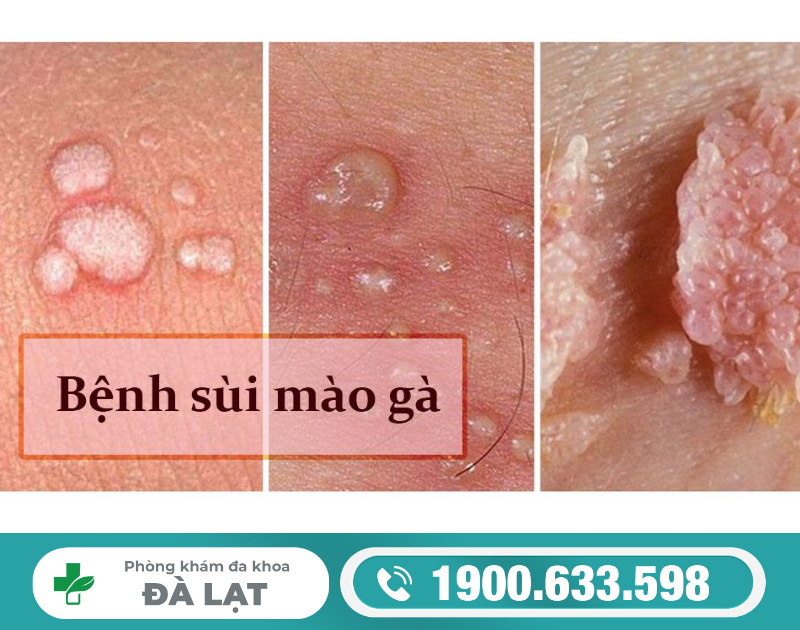 Phân Biệt Mụn Sinh Dục và Sùi Mào Gà 