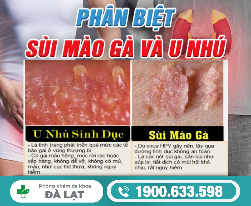 Phân Biệt Bệnh Sùi Mào Gà và U Nhú, U Mềm Lây 