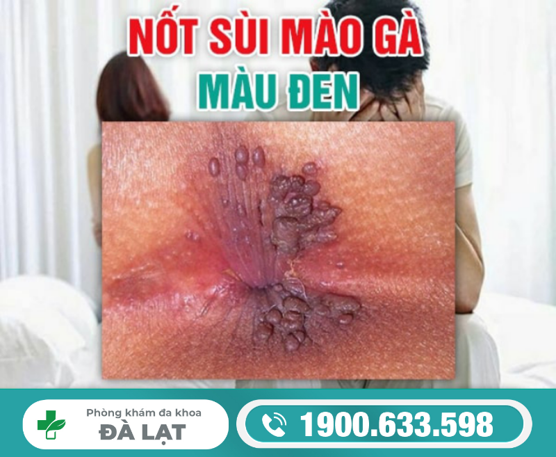 Nốt Sùi Mào Gà Màu Đen, Màu Trắng 
