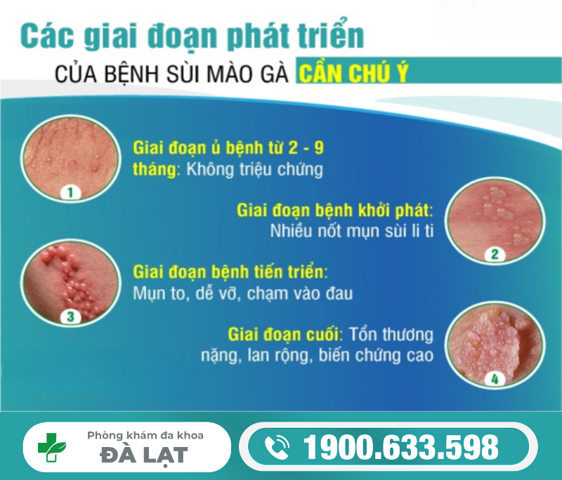 BỆNH SÙI MÀO GÀ Ở DÂY HÃM NAM GIỚI