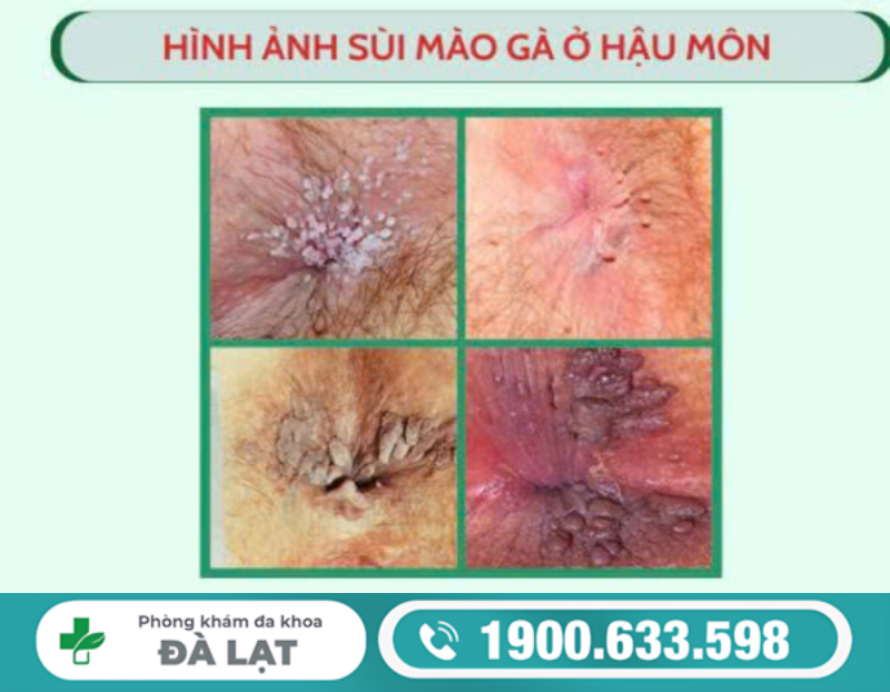 BỆNH SÙI MÀO GÀ Ở HẬU MÔN NAM GIỚI 