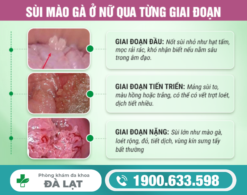 TÌM HIỂU VỀ BỆNH SÙI MÀO GÀ Ở CỬA MÌNH NỮ GIỚI