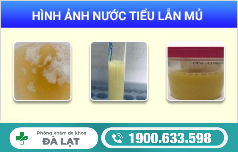 Tiểu Buốt Kèm Mủ Trắng 