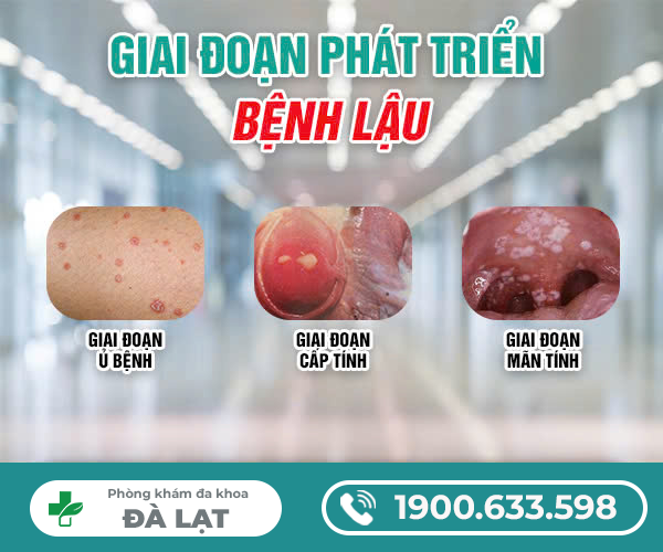 Bệnh Lậu Chảy Mủ Là Gì? 