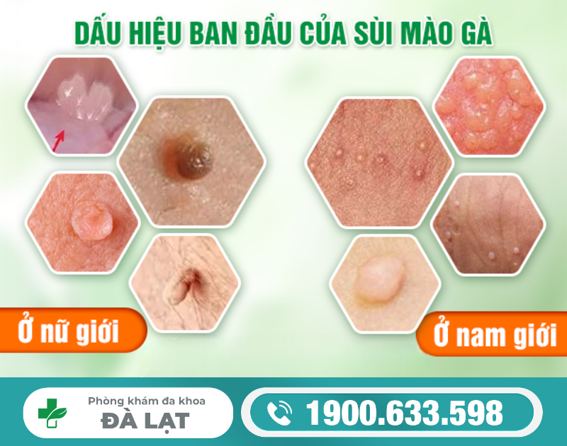 TÌM HIỂU VỀ ĐỐT BỆNH SÙI MÀO GÀ
