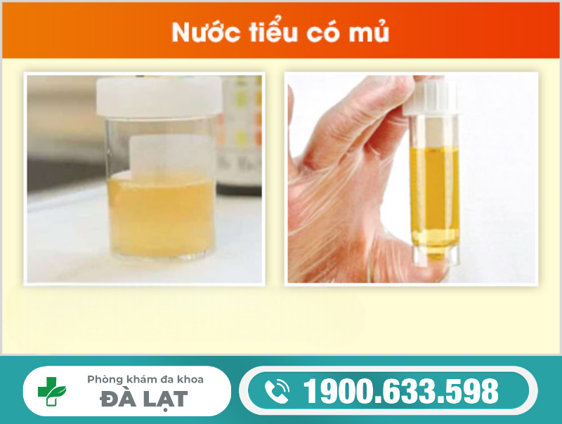 Đi Tiểu Buốt Có Mủ Màu Vàng 