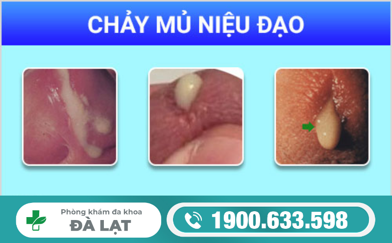 Niệu Đạo Chảy Mủ: Biểu Hiện và Cách Điều Trị