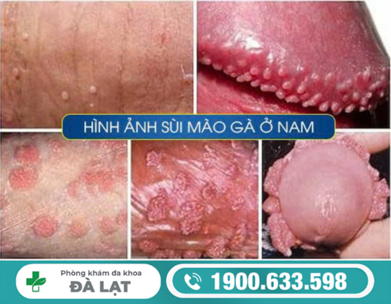 SÙI MÀO GÀ Ở NAM GIỚI – NHẬN BIẾT SỚM ĐỂ TRÁNH BIẾN CHỨNG