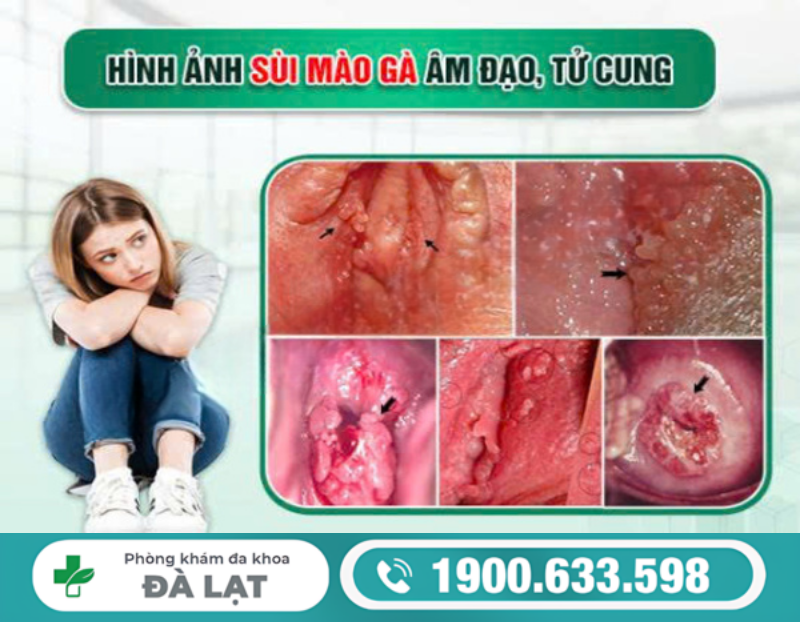 TÌM HIỂU HÌNH ẢNH SÙI MÀO GÀ Ở NỮ GIỚI
