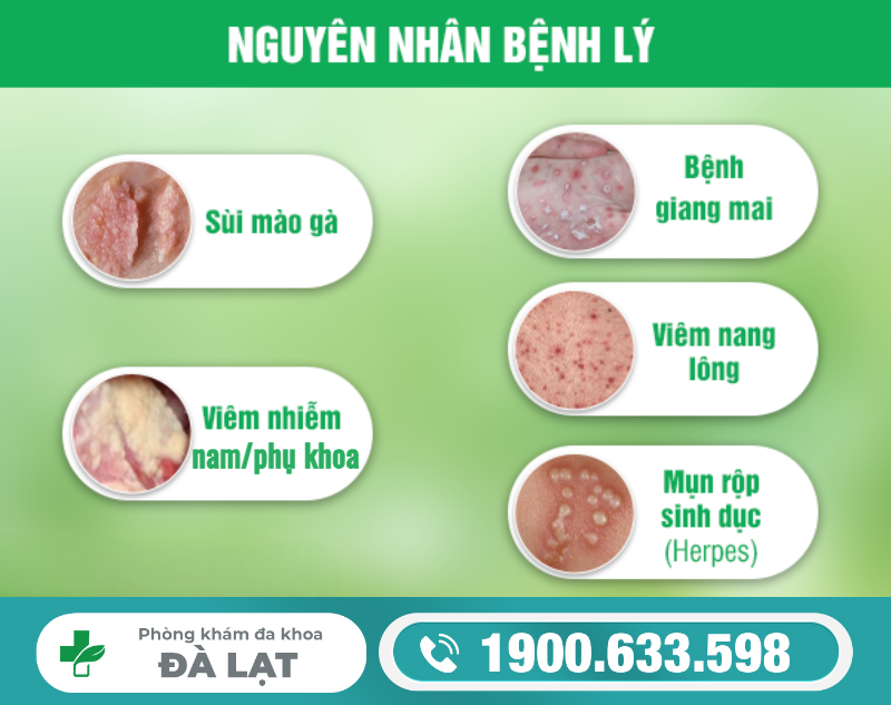 NỔI MỤN ĐỎ Ở BỘ PHẬN SINH DỤC NAM VÀ NỮ: NGUYÊN NHÂN VÀ CÁCH ĐIỀU TRỊ 