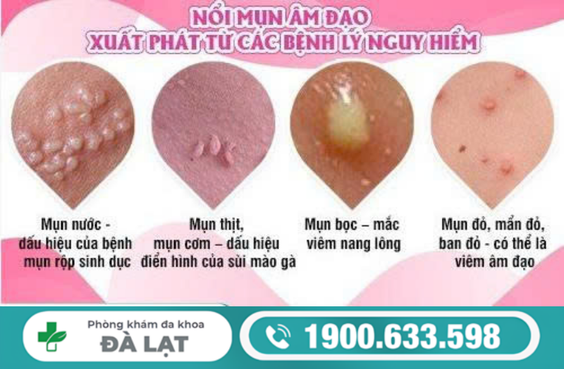 ÂM ĐẠO NỔI MỤN NGỨA: NGUYÊN NHÂN VÀ CÁCH ĐIỀU TRỊ 