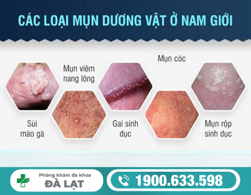 TÌM HIỂU DƯƠNG VẬT NỔI NỐT NGỨA VÀ CÁCH ĐIỀU TRỊ 