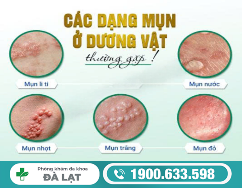 TÌM HIỂU NỐT LITI Ở ĐẦU DƯƠNG VẬT VÀ CÁCH ĐIỀU TRỊ 