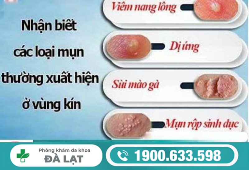 TÌM HIỂU VỀ CÁC NỐT Ở ÂM ĐẠO VÀ CÁCH ĐIỀU TRỊ 