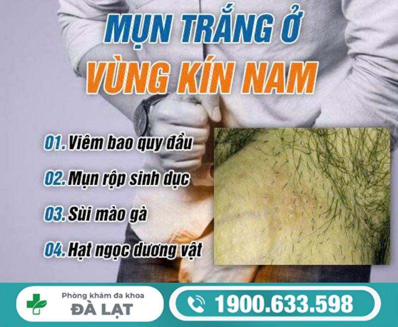 TÌM HIỂU BAO QUY ĐẦU CÓ NỐT TRẮNG VÀ CÁCH ĐIỀU TRỊ