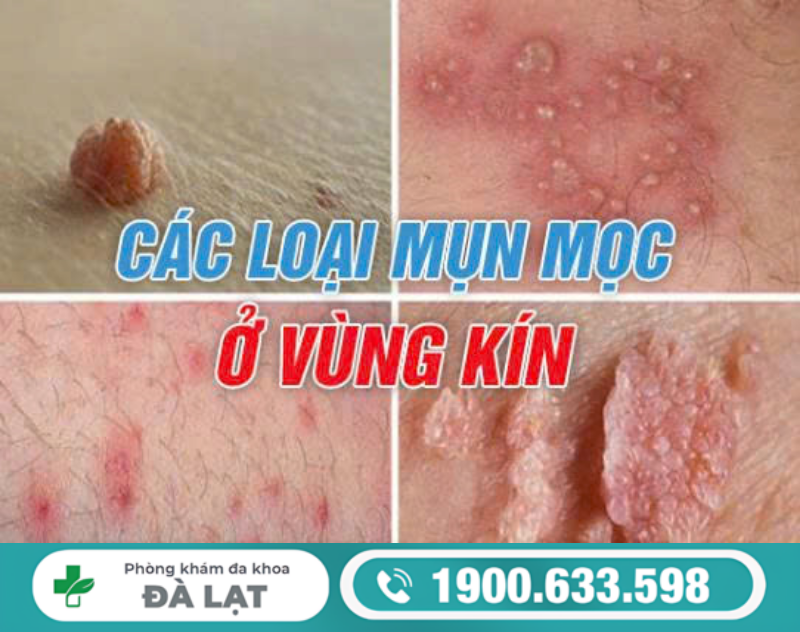 TÌM HIỂU VÙNG KÍN MỌC NỐT NGỨA VÀ CÁCH ĐIỀU TRỊ 