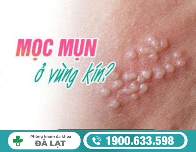 NỔI NỐT TRẮNG Ở VÙNG KÍN: NGUYÊN NHÂN VÀ CÁCH ĐIỀU TRỊ