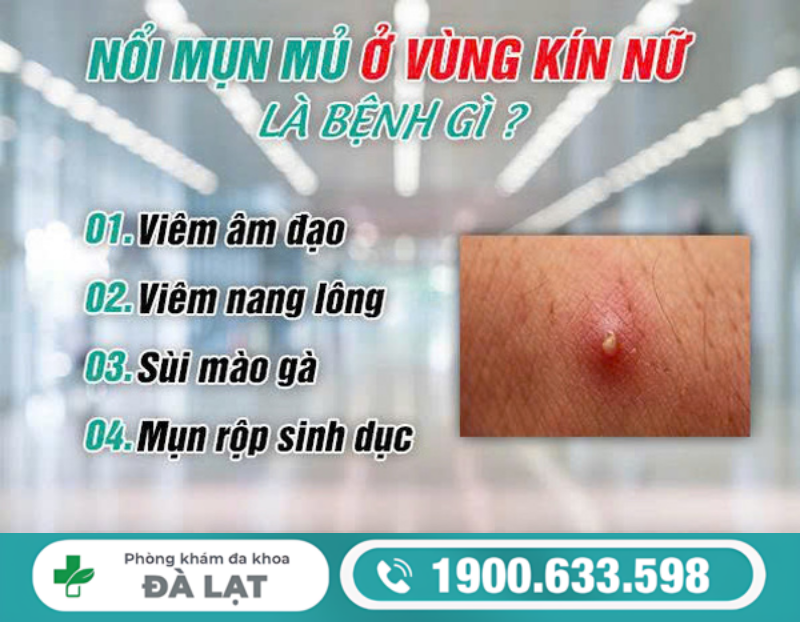NỔI MỤN MỦ Ở VÙNG KÍN NỮ GIỚI: NGUYÊN NHÂN VÀ CÁCH ĐIỀU TRỊ 