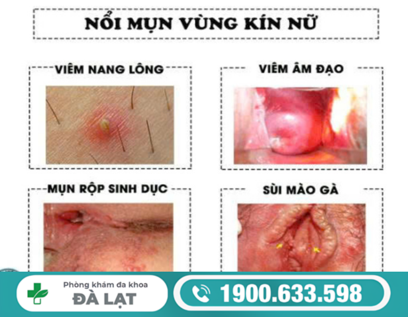 MỌC MỤN NGỨA Ở VÙNG KÍN NỮ: NGUYÊN NHÂN VÀ CÁCH ĐIỀU TRỊ