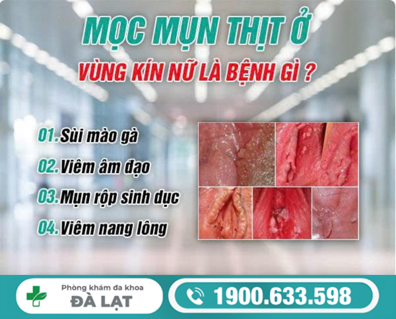 MỌC MỤN THỊT Ở VÙNG KÍN NỮ: NGUYÊN NHÂN VÀ CÁCH ĐIỀU TRỊ 
