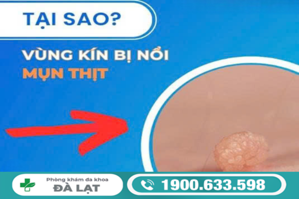 NỔI MỤN THỊT Ở VÙNG KÍN NAM VÀ CÁCH ĐIỀU TRỊ 