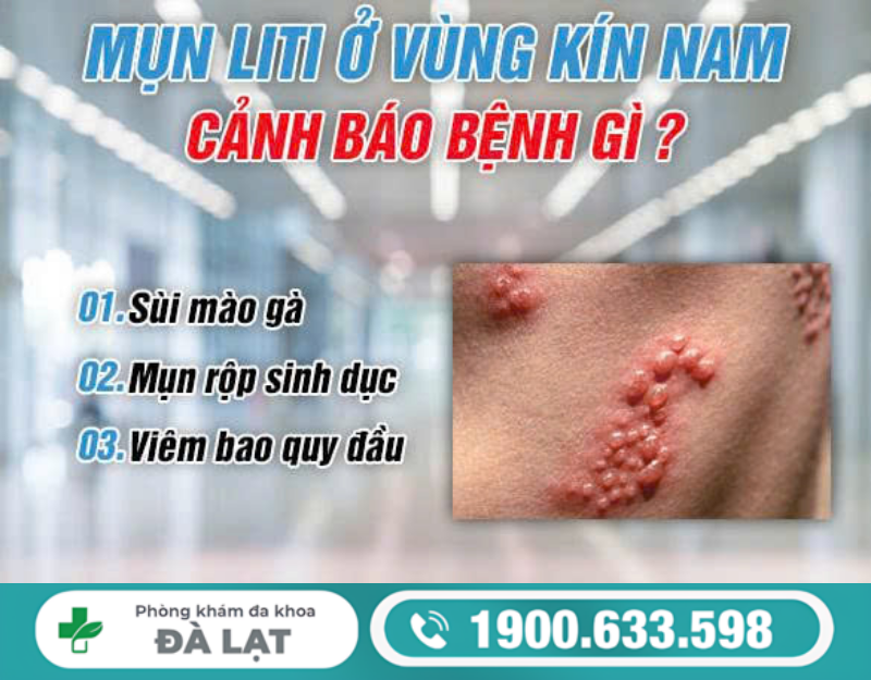MỤN LITI Ở VÙNG KÍN NAM VÀ CÁCH ĐIỀU TRỊ