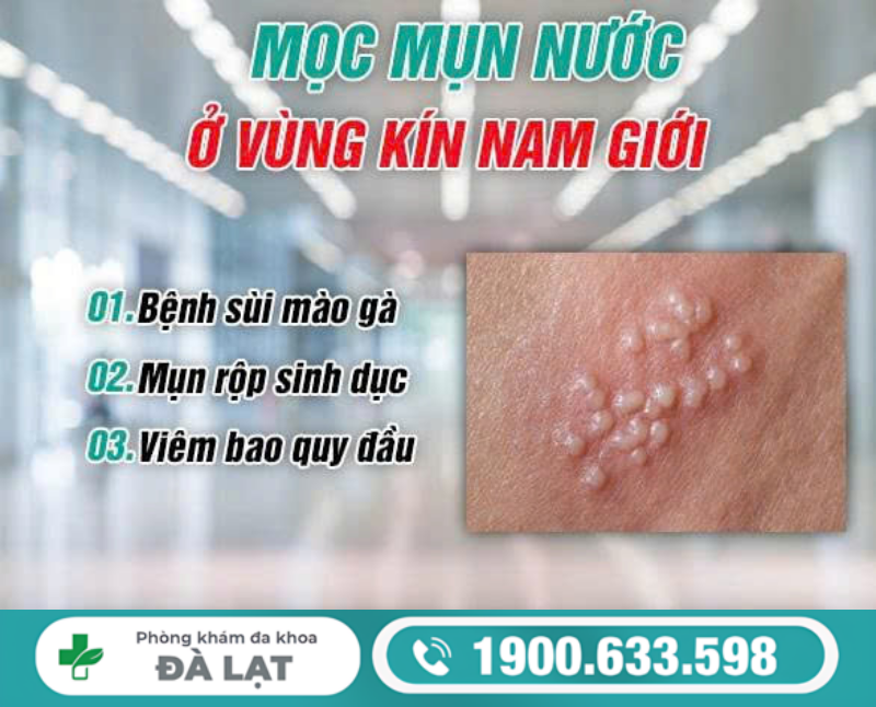 MỌC MỤN NƯỚC Ở VÙNG KÍN NAM VÀ CÁCH ĐIỀU TRỊ