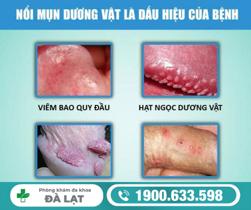 MỌC MỤN BỌC Ở VÙNG KÍN NAM VÀ CÁCH ĐIỀU TRỊ 
