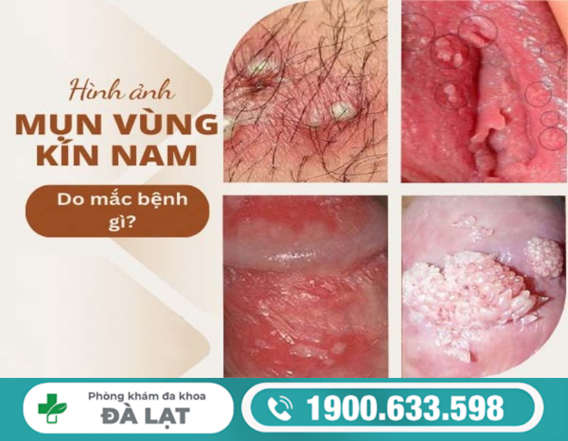 MỌC MỤN MỦ Ở VÙNG KÍN NAM VÀ CÁCH ĐIỀU TRỊ 