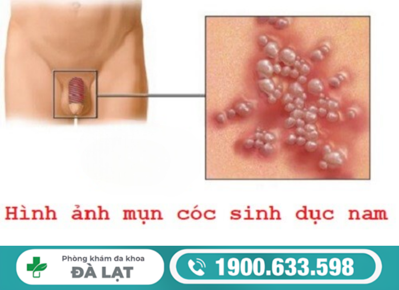 NỔI MỤN CÓC Ở VÙNG KÍN NAM VÀ CÁCH ĐIỀU TRỊ