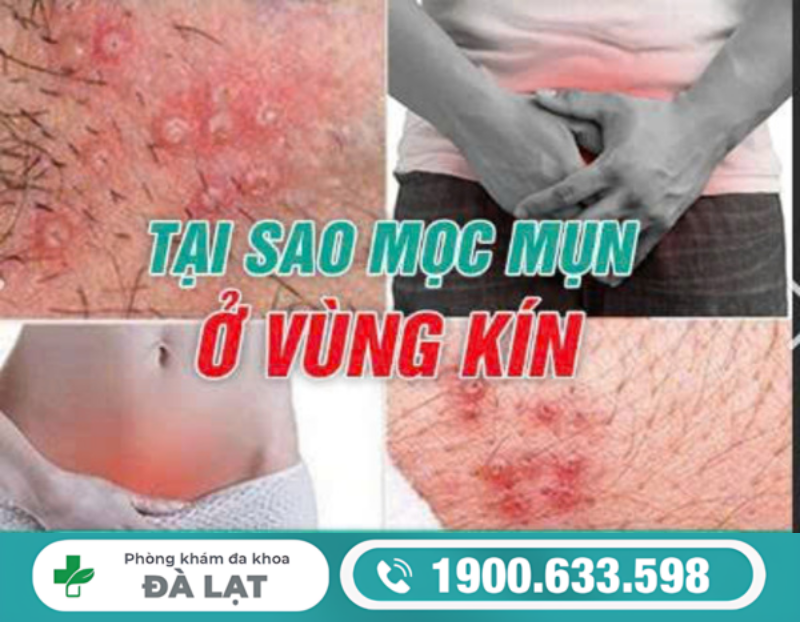  NAM VÀ NỮ BỊ NỔI MỤN ĐỎ Ở MÉP VÙNG KÍN VÀ CÁCH ĐIỀU TRỊ 