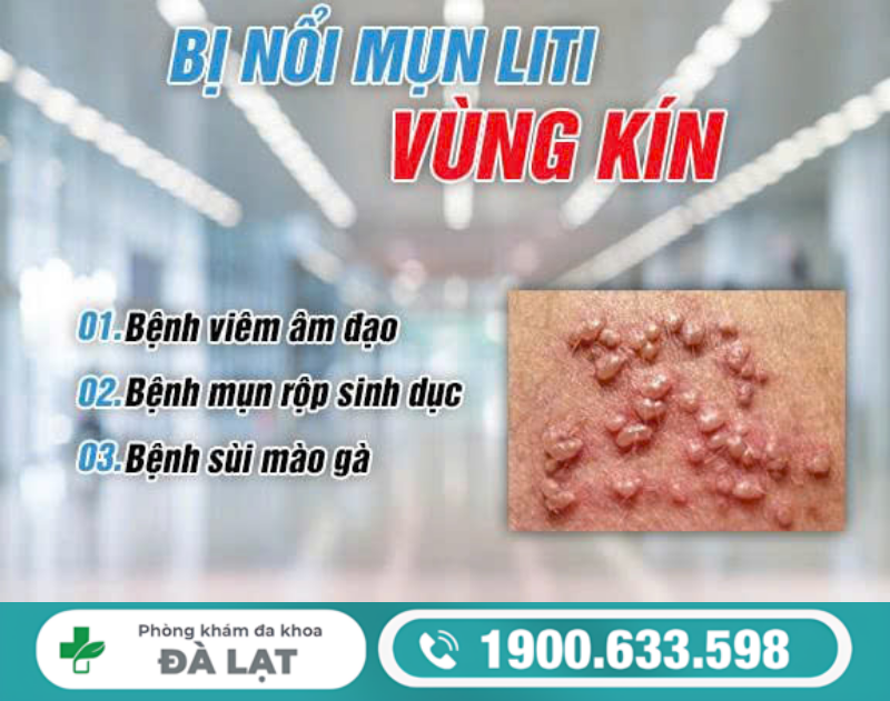 NAM NỮ BỊ NỔI MỤN LITI Ở VÙNG KÍN VÀ CÁCH ĐIỀU TRỊ 