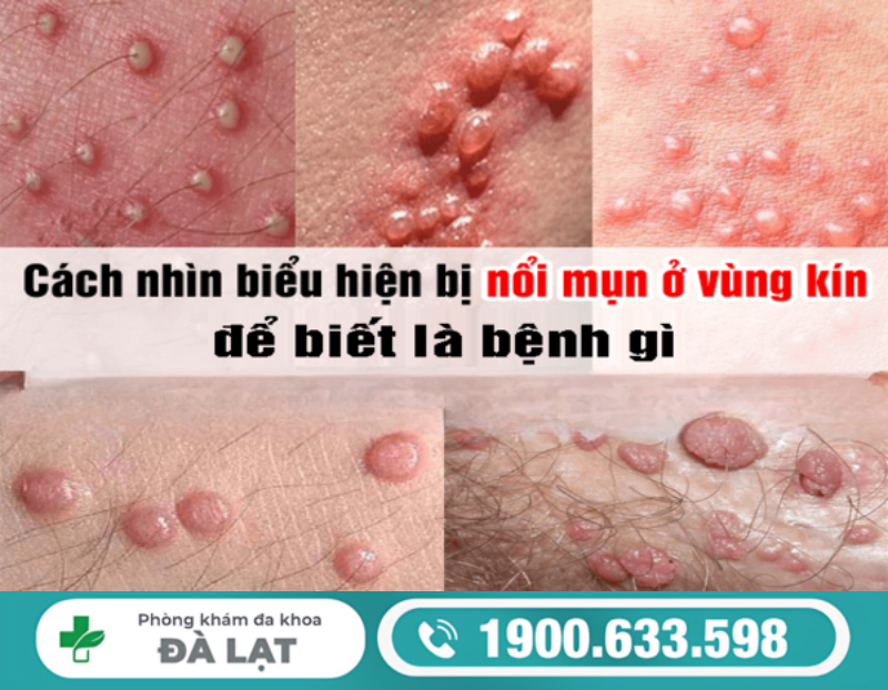 NAM VÀ NỮ NỔI MỤN MỦ VÙNG KÍN VÀ CÁCH ĐIỀU TRỊ