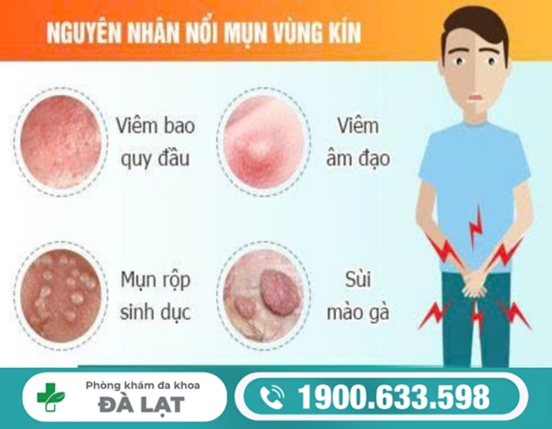 CÁCH CHỮA MỤN MỦ VÙNG KÍN Ở NAM VÀ NỮ 