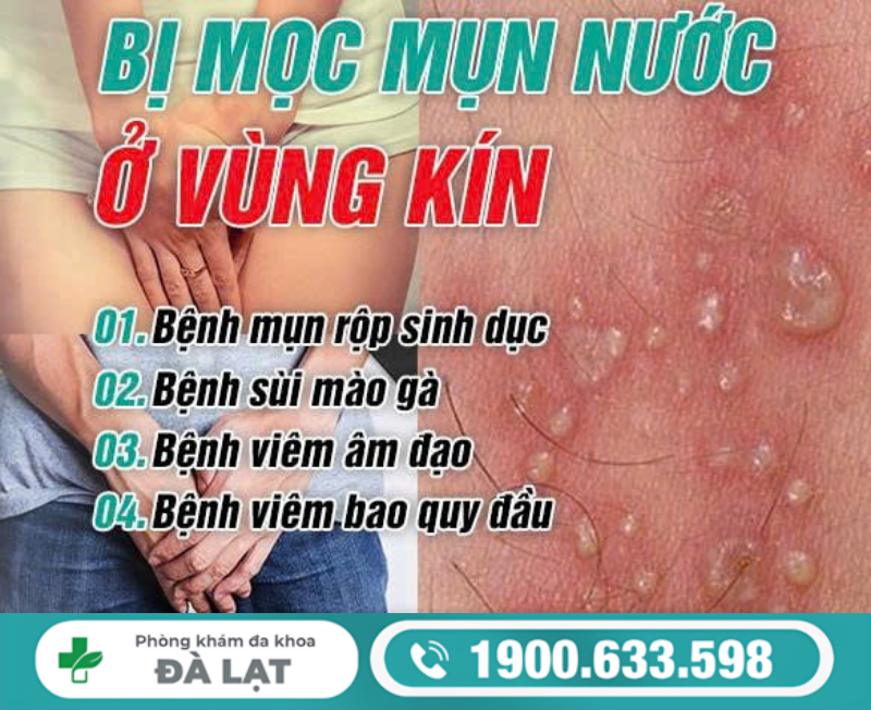 TÌM HIỂU CÁCH CHỮA MỤN NƯỚC VÙNG KÍN Ở NAM VÀ NỮ HIỆU QUẢ 