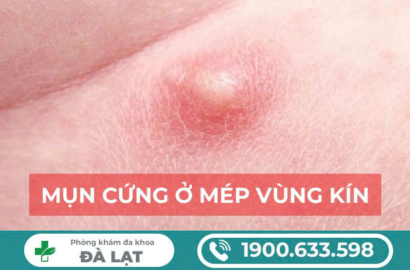 TÌM HIỂU CÁCH CHỮA MỤN CỨNG Ở VÙNG KÍN NAM VÀ NỮ 