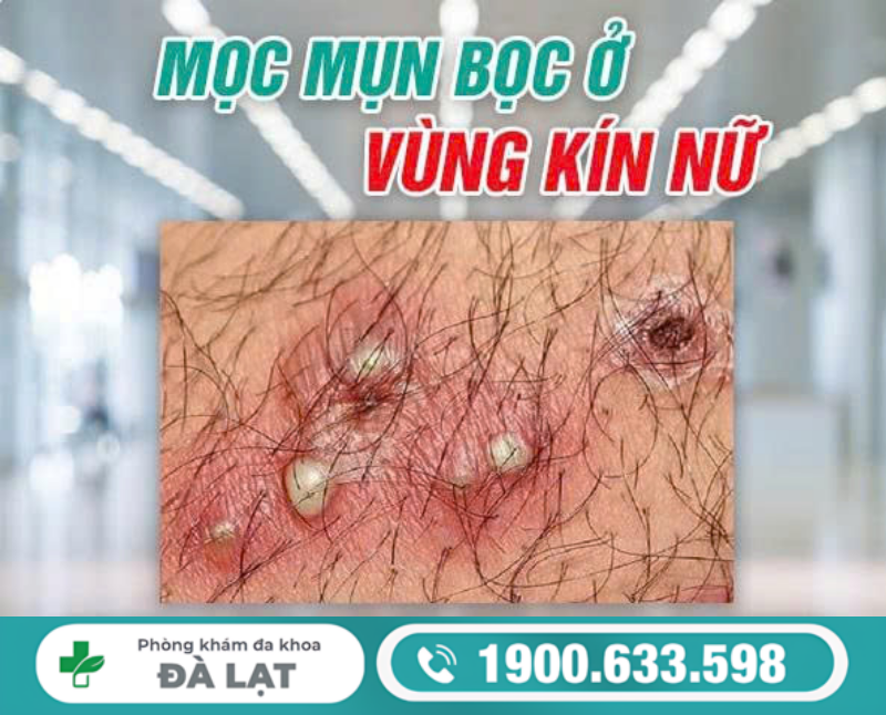 TÌM HIỂU NỔI MỤN BỌC Ở ÂM ĐẠO VÀ CÁCH ĐIỀU TRỊ 