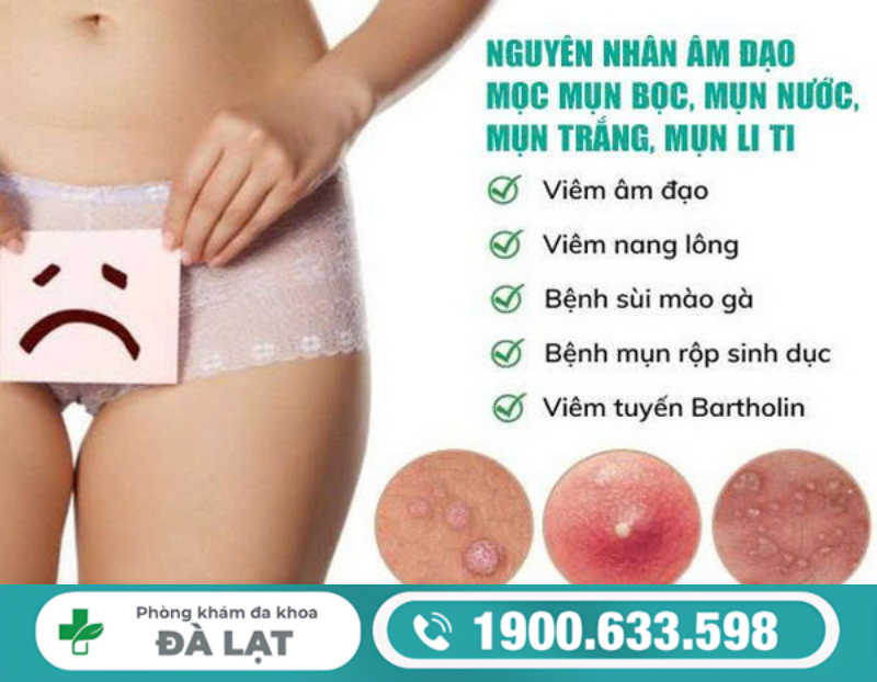 TÌM HIỂU VỀ ÂM ĐẠO NỔI MỤN LITI VÀ CÁCH ĐIỀU TRỊ 